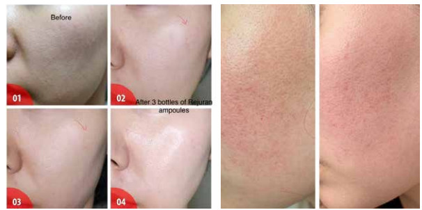 Before & After pictires of AOMA PDRN AOMA PDRN 之前和之后的照片