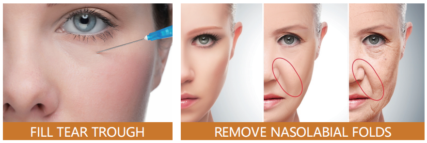 面部年轻化：玻尿酸注射